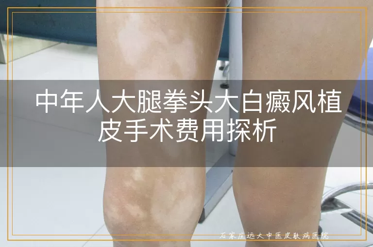中年人大腿拳头大白癜风植皮手术费用探析