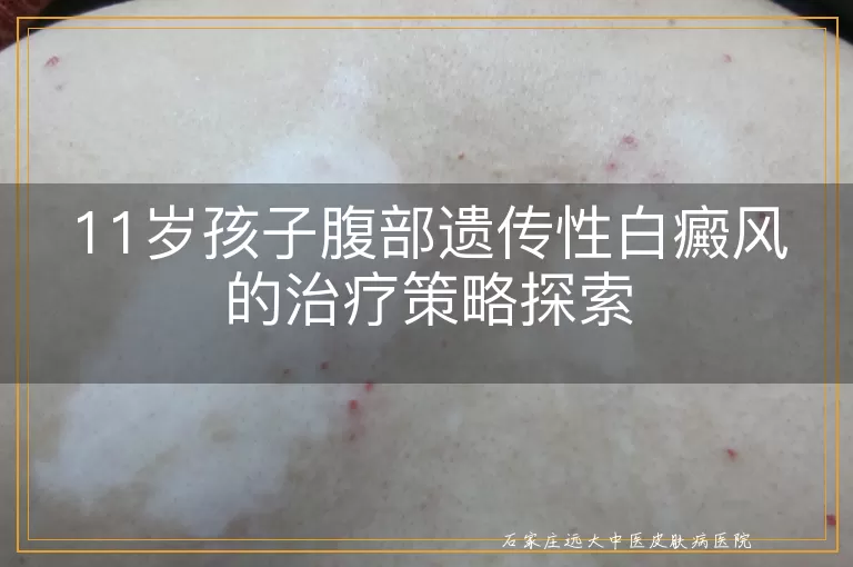 11岁孩子腹部遗传性白癜风的治疗策略探索