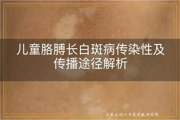 儿童胳膊长白斑病传染性及传播途径解析