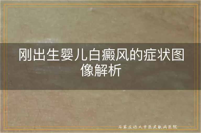 刚出生婴儿白癜风的症状图像解析