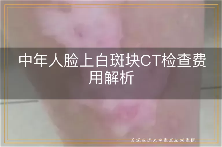 中年人脸上白斑块CT检查费用解析