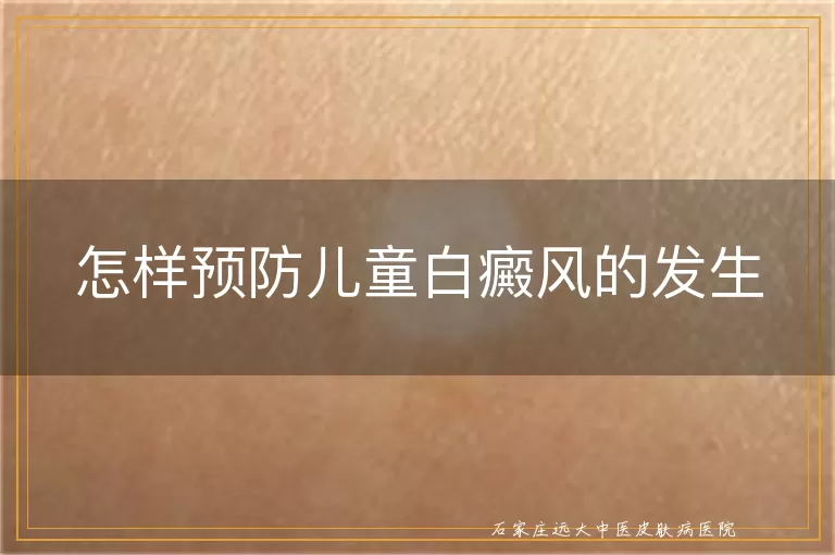 怎样预防儿童白癜风的发生
