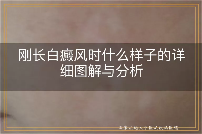 刚长白癜风时什么样子的详细图解与分析