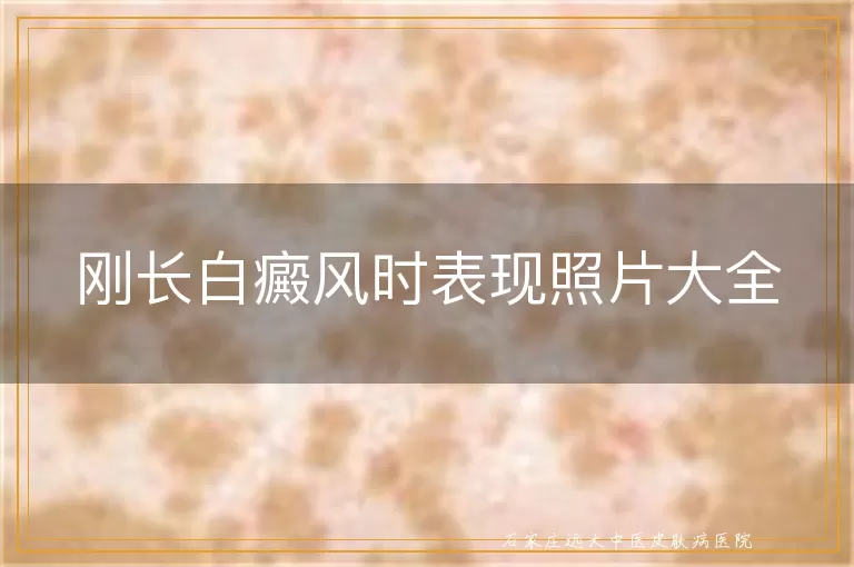 刚长白癜风时表现照片大全