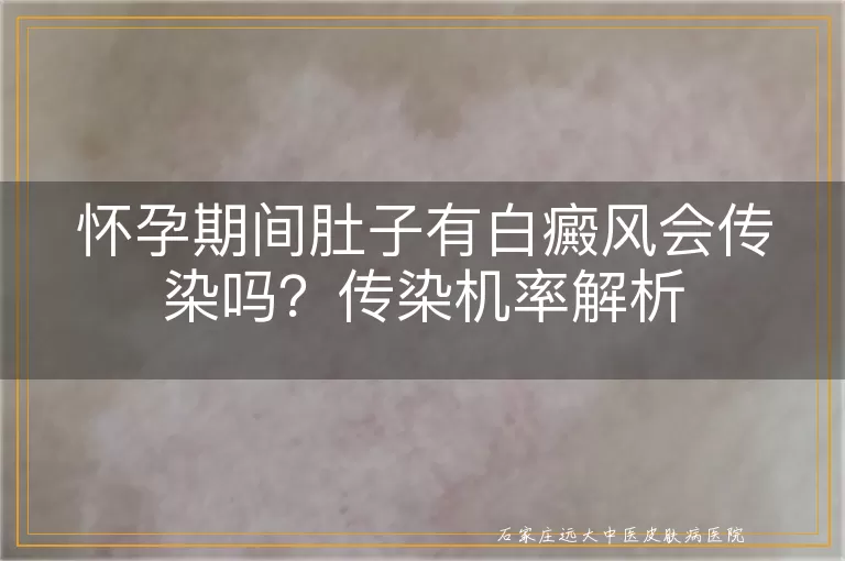 怀孕期间肚子有白癜风会传染吗？传染机率解析