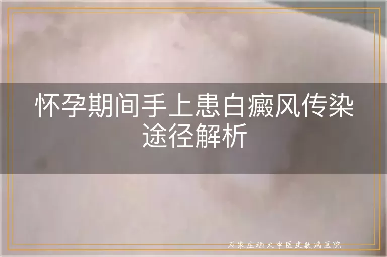 怀孕期间手上患白癜风传染途径解析