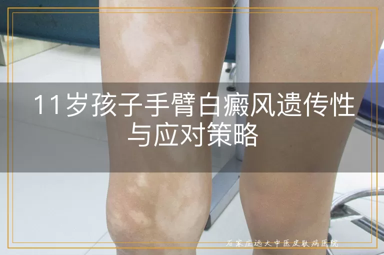 11岁孩子手臂白癜风遗传性与应对策略