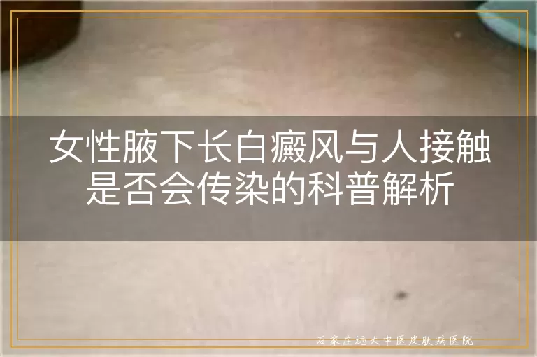 女性腋下长白癜风与人接触是否会传染的科普解析