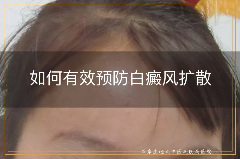 如何有效预防白癜风扩散