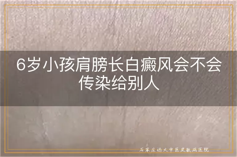 6岁小孩肩膀长白癜风会不会传染给别人