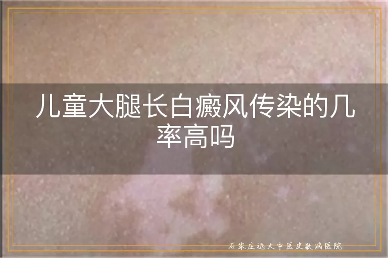 儿童大腿长白癜风传染的几率高吗
