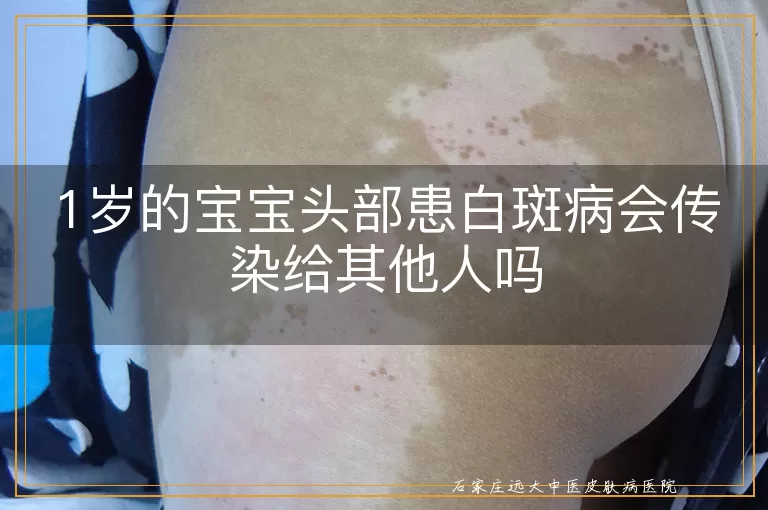 1岁的宝宝头部患白斑病会传染给其他人吗