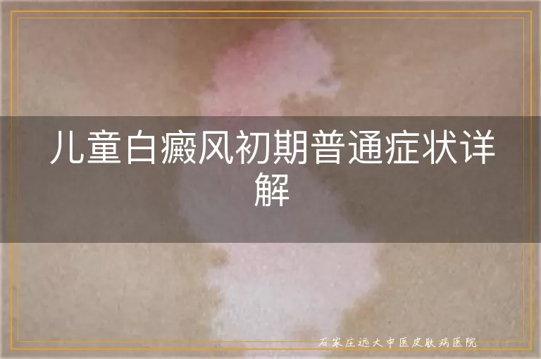 儿童白癜风初期普通症状详解