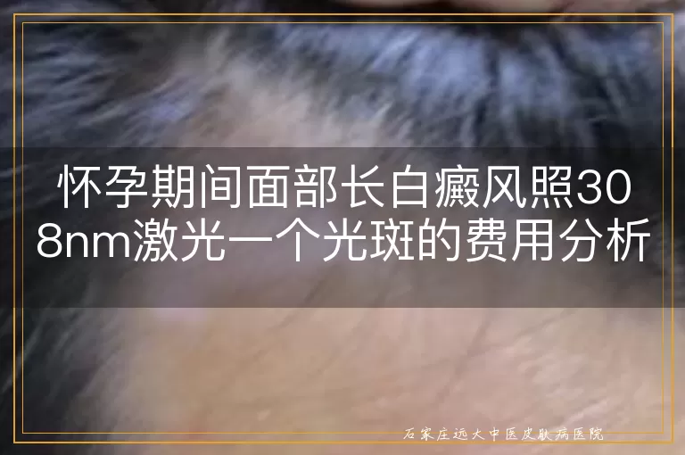 怀孕期间面部长白癜风照308nm激光一个光斑的费用分析