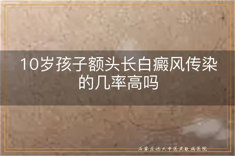 10岁孩子额头长白癜风传染的几率高吗