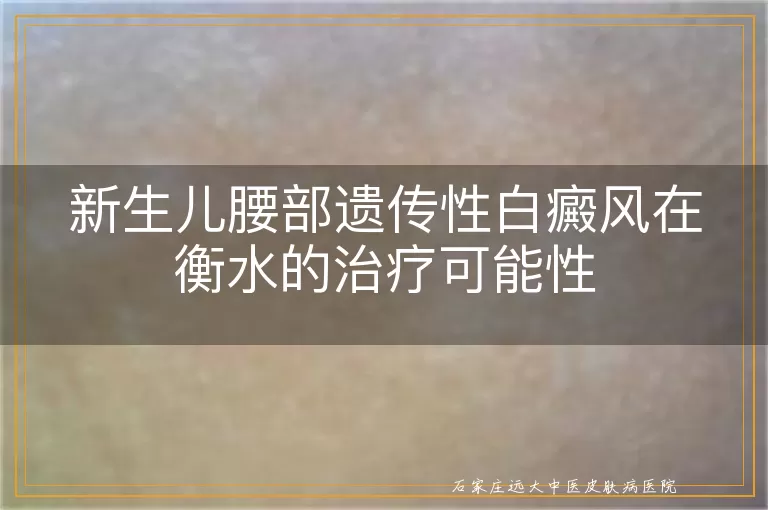 新生儿腰部遗传性白癜风在衡水的治疗可能性