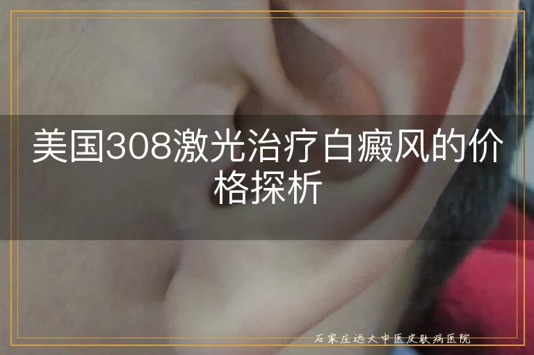 美国308激光治疗白癜风的价格探析