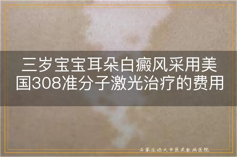 三岁宝宝耳朵白癜风采用美国308准分子激光治疗的费用探讨