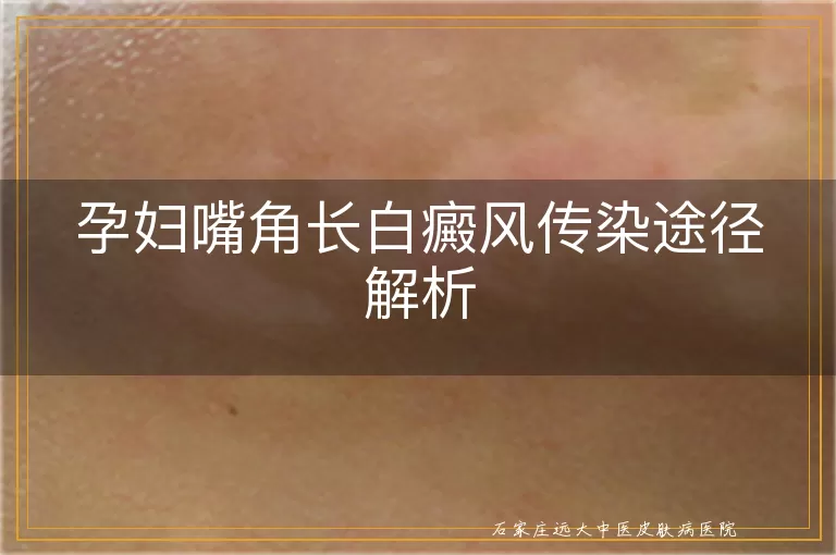 孕妇嘴角长白癜风传染途径解析