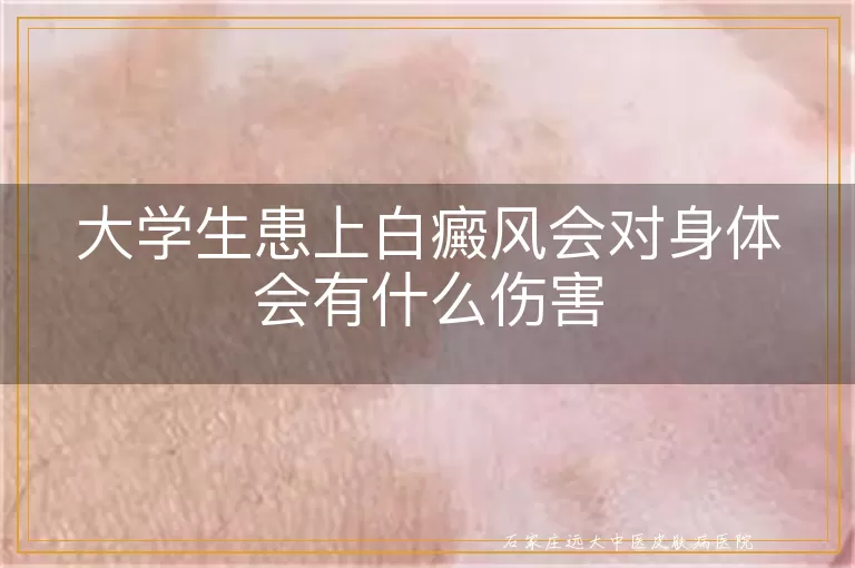 大学生患上白癜风会对身体会有什么伤害