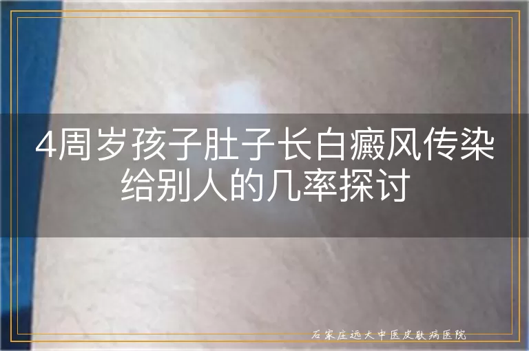 4周岁孩子肚子长白癜风传染给别人的几率探讨