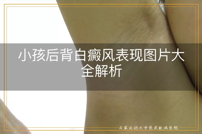 小孩后背白癜风表现图片大全解析