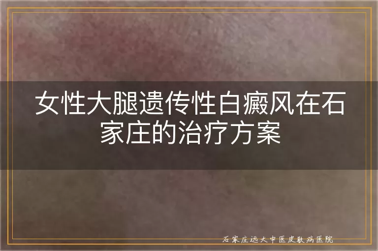 女性大腿遗传性白癜风在石家庄的治疗方案