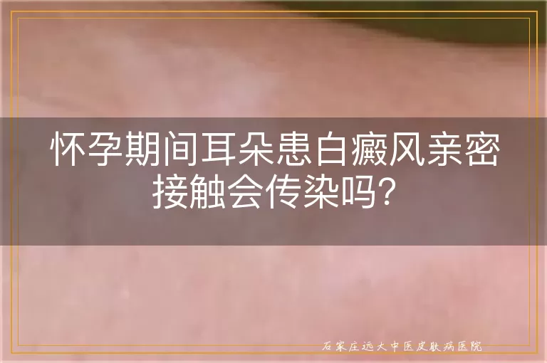 怀孕期间耳朵患白癜风亲密接触会传染吗？