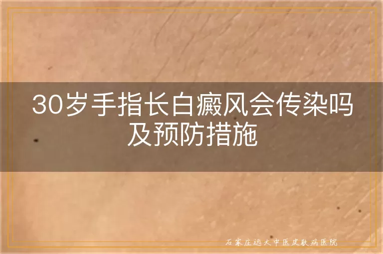 30岁手指长白癜风会传染吗及预防措施