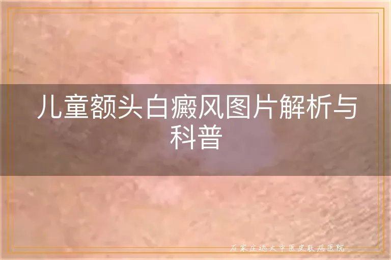 儿童额头白癜风图片解析与科普