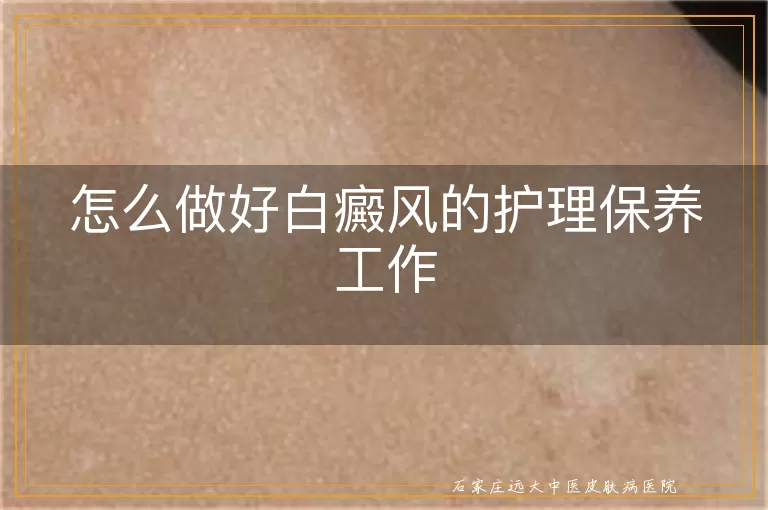 怎么做好白癜风的护理保养工作