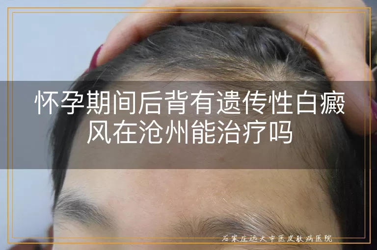 怀孕期间后背有遗传性白癜风在沧州能治疗吗
