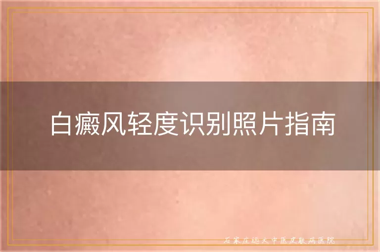 白癜风轻度识别照片指南