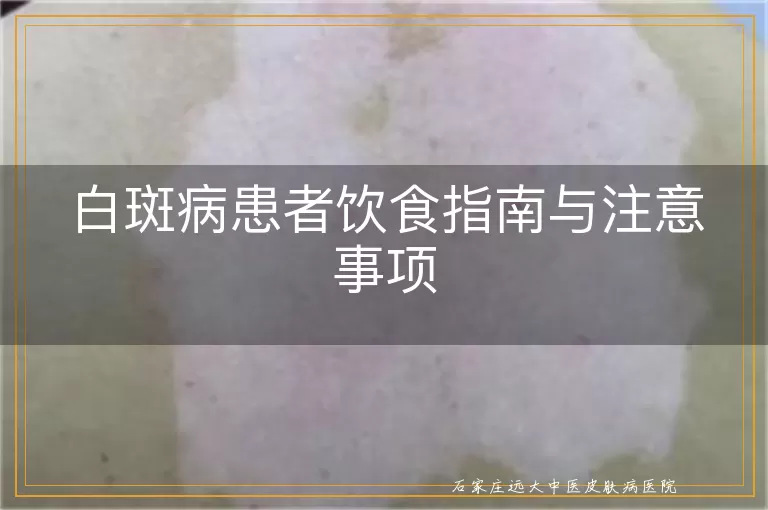 白斑病患者饮食指南与注意事项