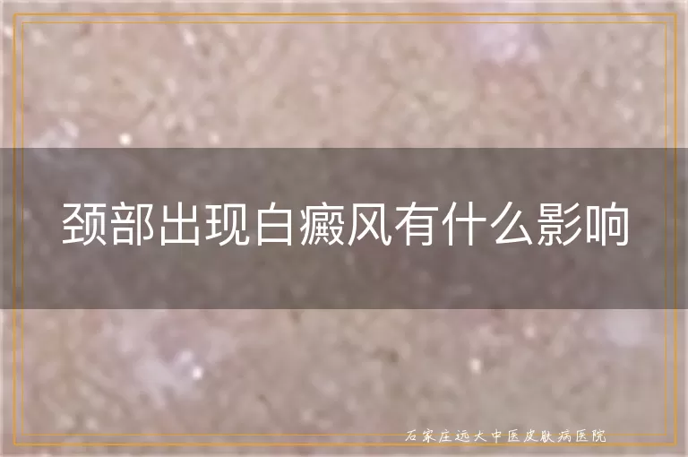颈部出现白癜风有什么影响