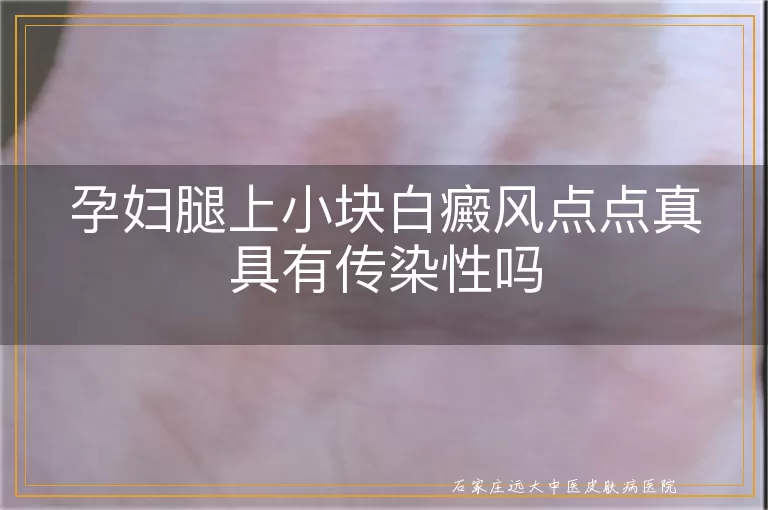 孕妇腿上小块白癜风点点真具有传染性吗