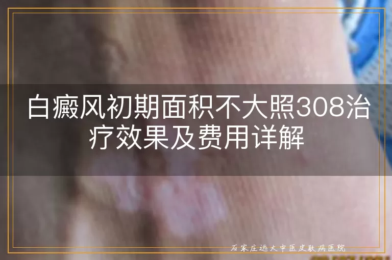 白癜风初期面积不大照308治疗效果及费用详解