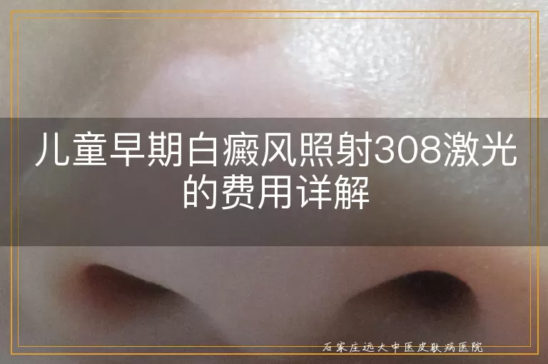 儿童早期白癜风照射308激光的费用详解