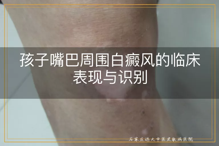 孩子嘴巴周围白癜风的临床表现与识别