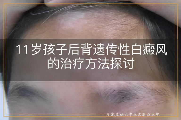 11岁孩子后背遗传性白癜风的治疗方法探讨