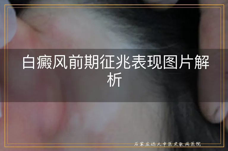 白癜风前期征兆表现图片解析