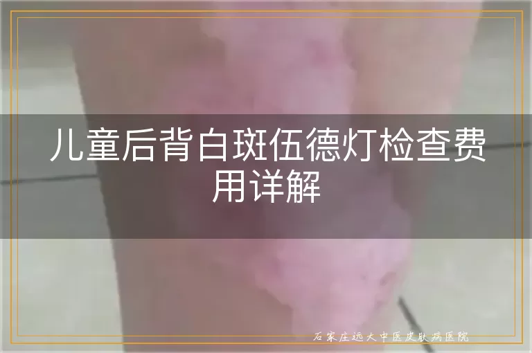 儿童后背白斑伍德灯检查费用详解