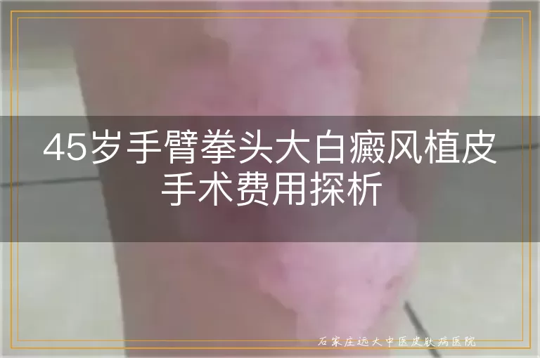 45岁手臂拳头大白癜风植皮手术费用探析
