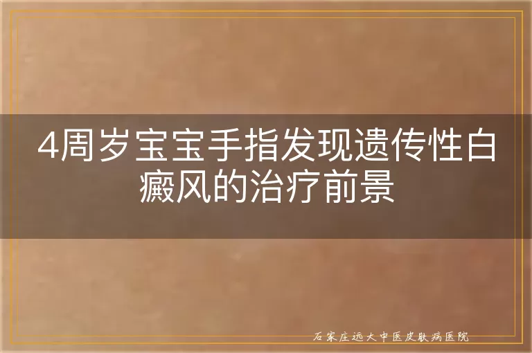 4周岁宝宝手指发现遗传性白癜风的治疗前景