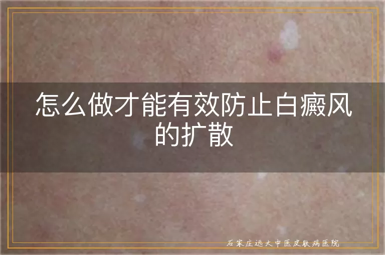 怎么做才能有效防止白癜风的扩散