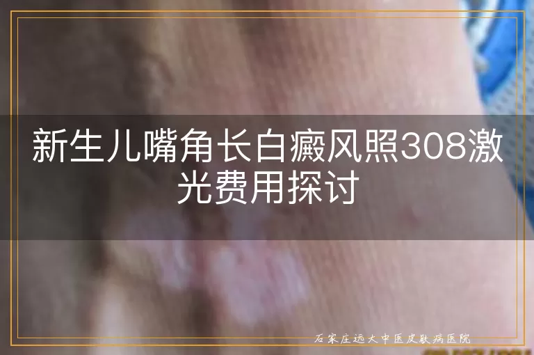 新生儿嘴角长白癜风照308激光费用探讨