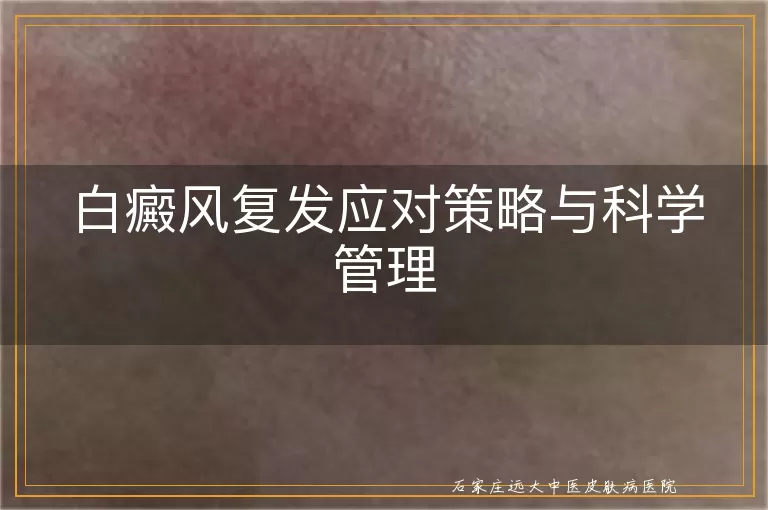 白癜风复发应对策略与科学管理