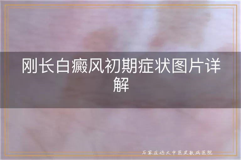 刚长白癜风初期症状图片详解