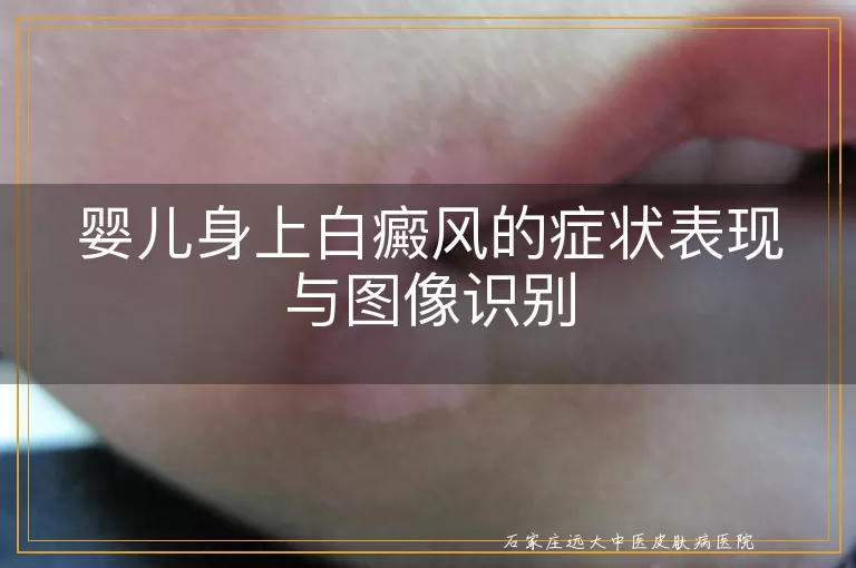 婴儿身上白癜风的症状表现与图像识别