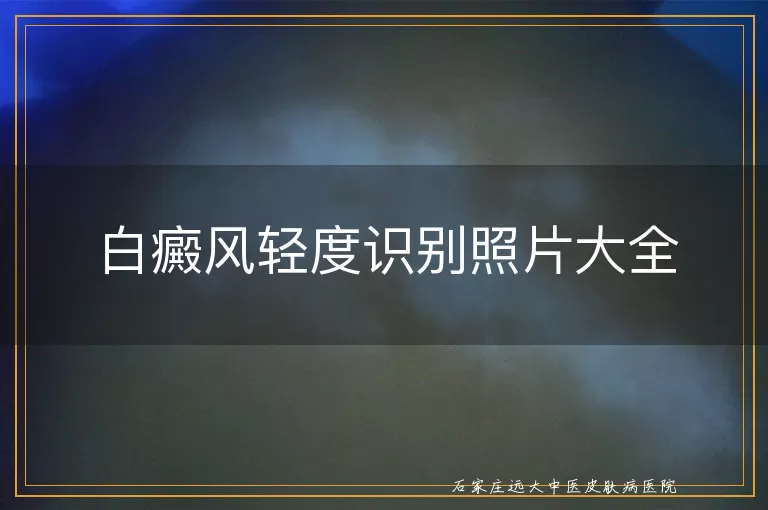 白癜风轻度识别照片大全